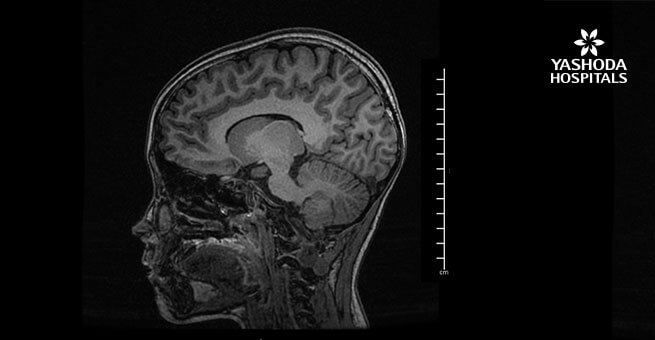 What is the impact of Brain Tumor in young children?