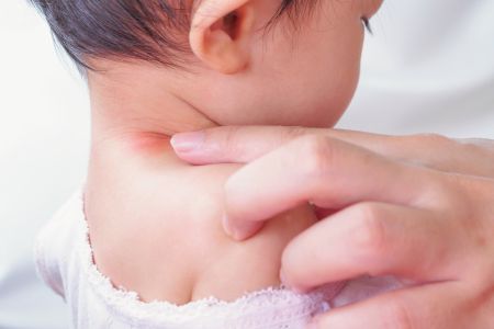 What is the treatment for Congenital Muscular Torticollis