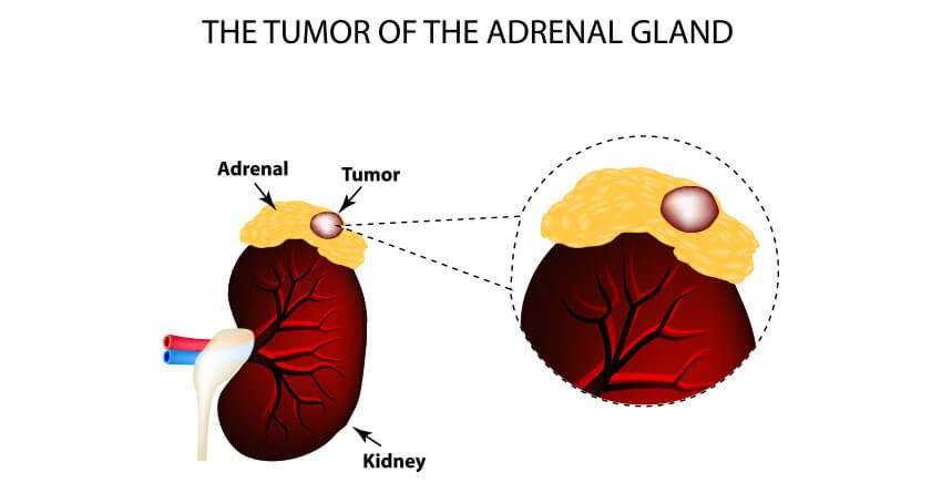 adrenal cancer
