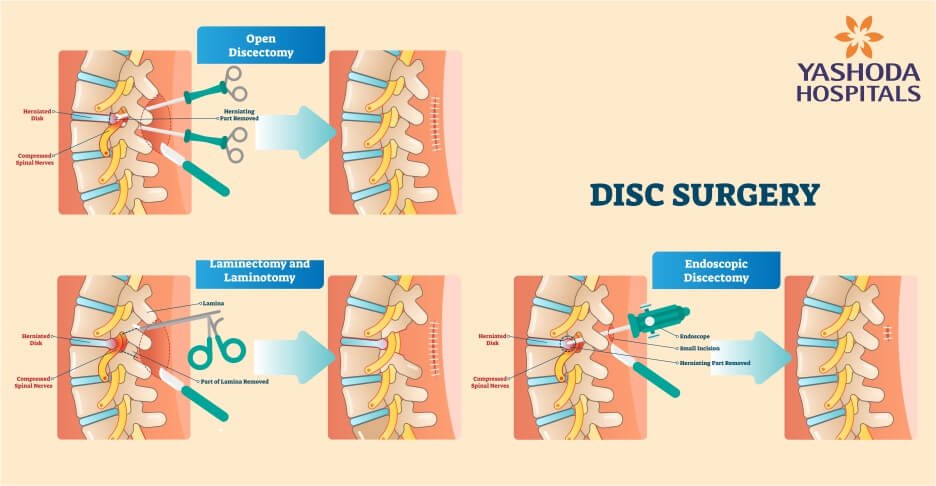 minimally invasive spine surgery - endoscopic spine surgery