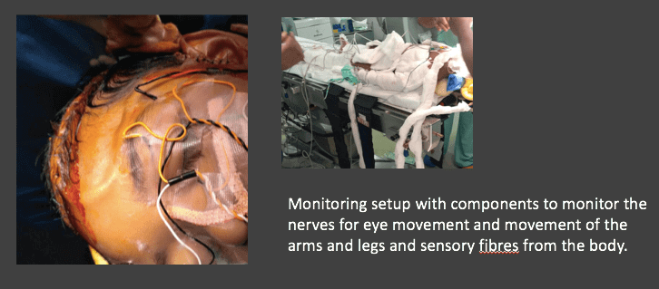 brainstem tumor surgery monitoring