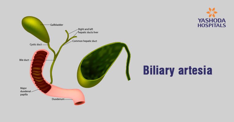 What are the causes of biliary atresia