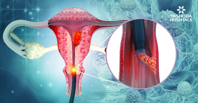 cervical-cancer-image