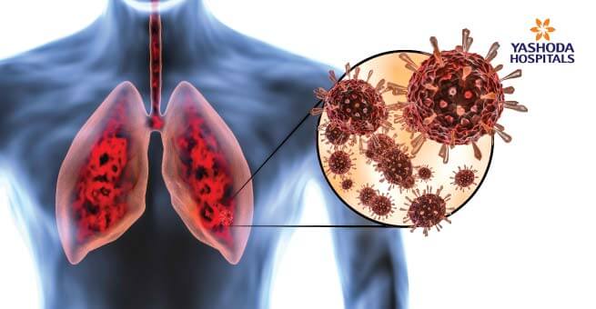 coronavirus attacks human lungs causes pneumonia