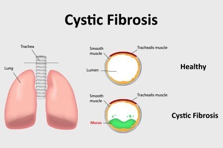 What is cystic fibrosis