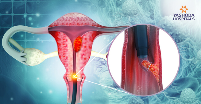 How to detect cervical cancer?