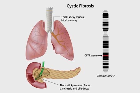 Diagnosis for Cystic Fibrosis