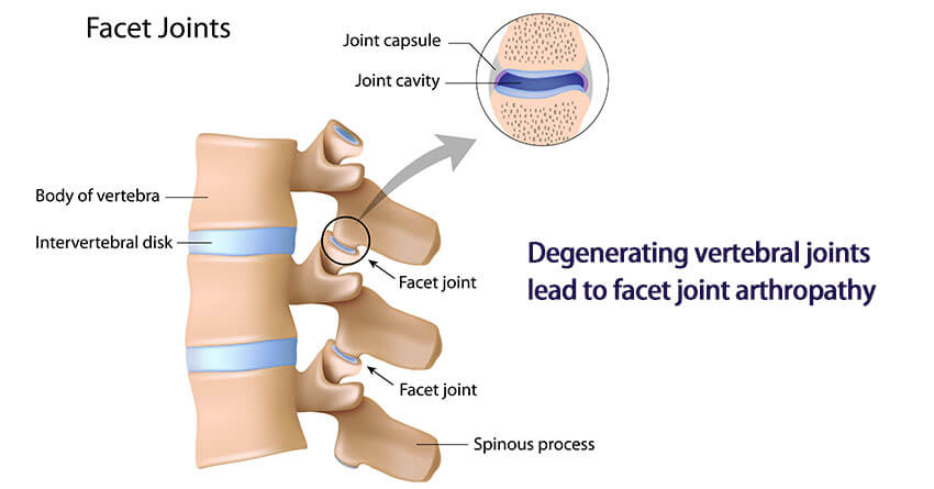 What is facet joint arthropathy