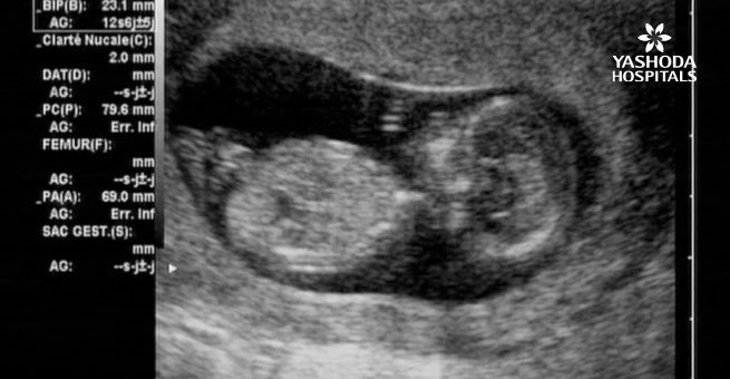 fetal ultrasound in the first trimester