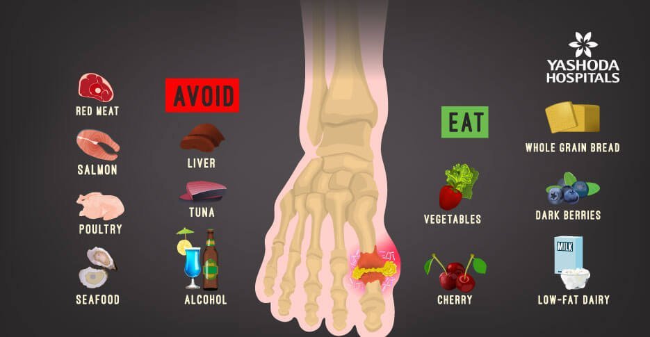 foods to eat and avoid with gout