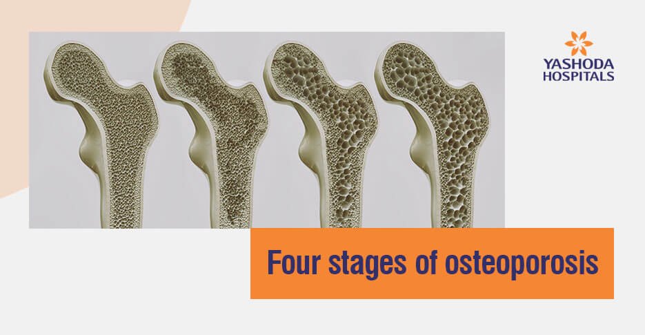 four stages of osteoporosis