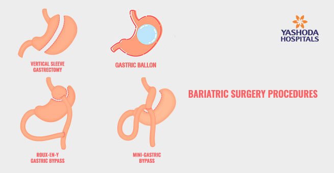Bariatric Surgery Procedure