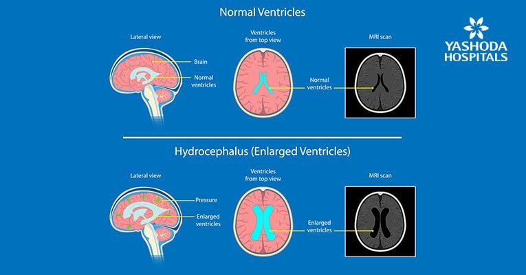 hydrocephalus diagnosed by doctors