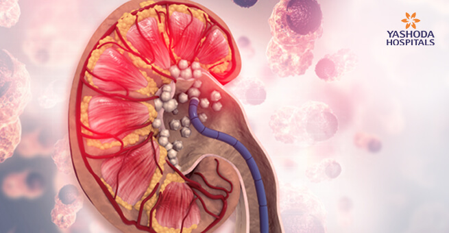 kidney-stones-telugu-image