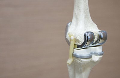knee implants