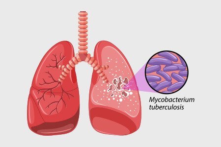 lung infected with tuberculosis