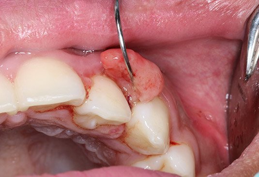 Oral cancer or mouth cancer