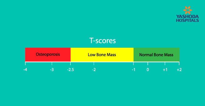 osteoporosis-body3