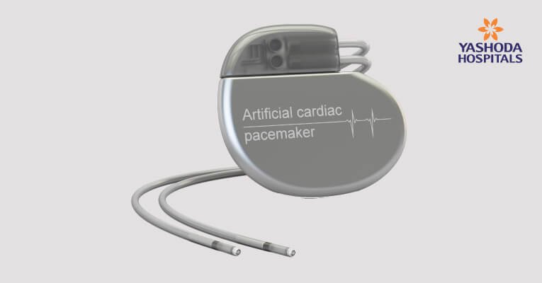 pacemaker - electronic device