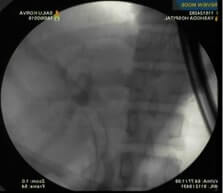 periampullary carcinoma X ray showing biliary SEMS