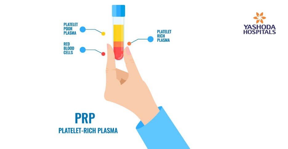 platelet rich plasma-PRP