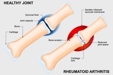 what is rheumatoid arthritis