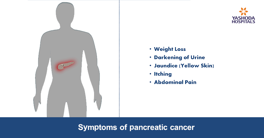 signs & symptoms of pancreatic cancer