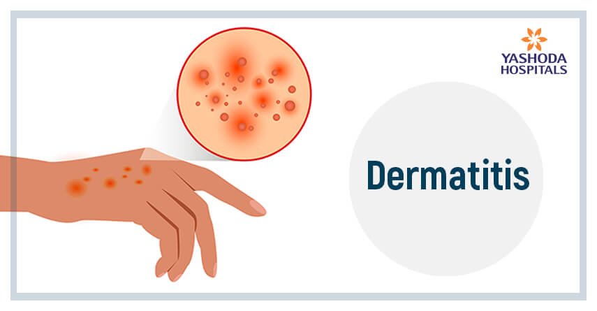 skin-dermatitis