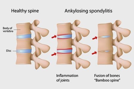What is spondyloarthritis, spondylitis or spondyloarthroscopy