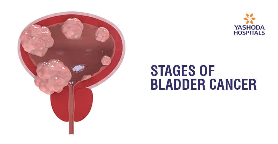 stages blader cancer