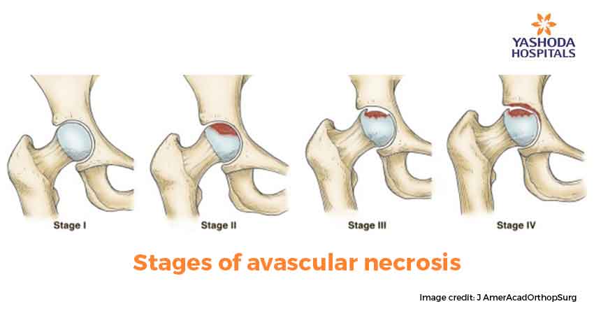 stages of avascular necrosis