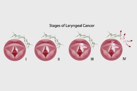 stages of throat cancer