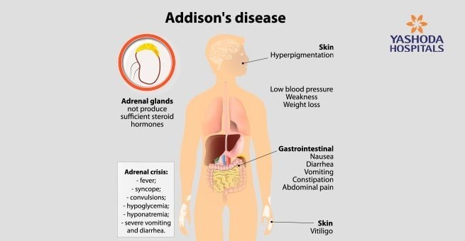 symptoms of adrenal gland disorders