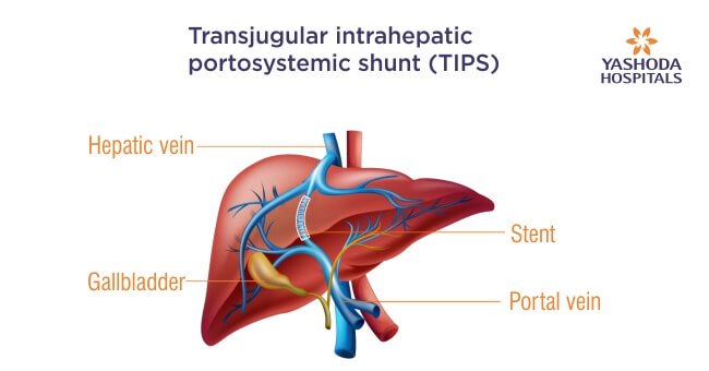 Portal hypertension and TIPS (Transjugular Intrahepatic Portosystemic Shunt)