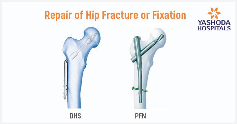 Hip Fracture: symptoms, causes, diagnosis, treatment, risk factors