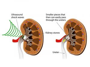 treatment for kidney stones