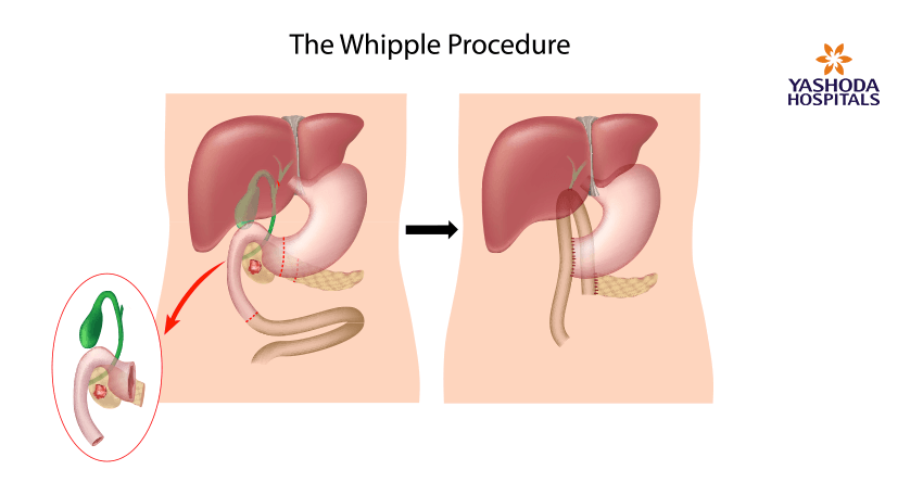 treatment options of pancreatic cancer-Whipple procedure