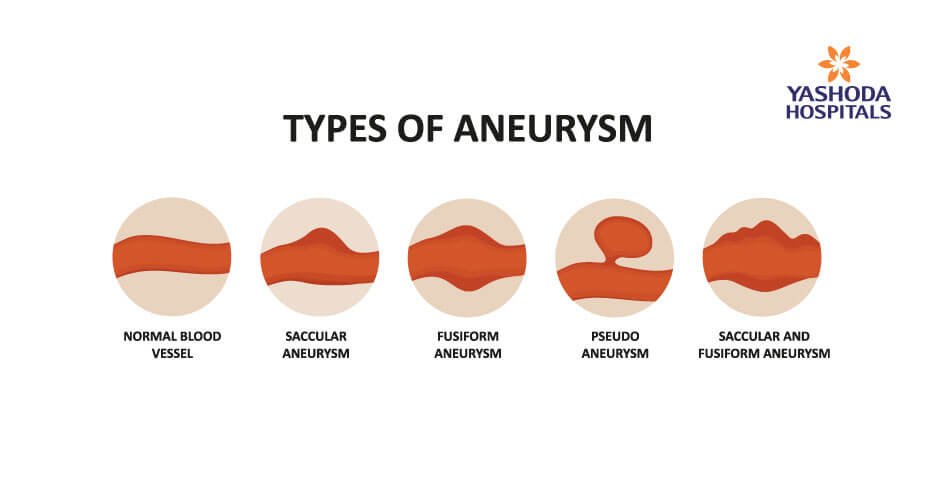 types of aneurysm