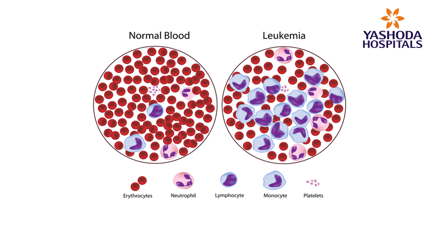 types of blood cancers-leukaemia-lymphoma-myeloma