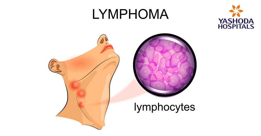 types of blood cancers-lymphoma