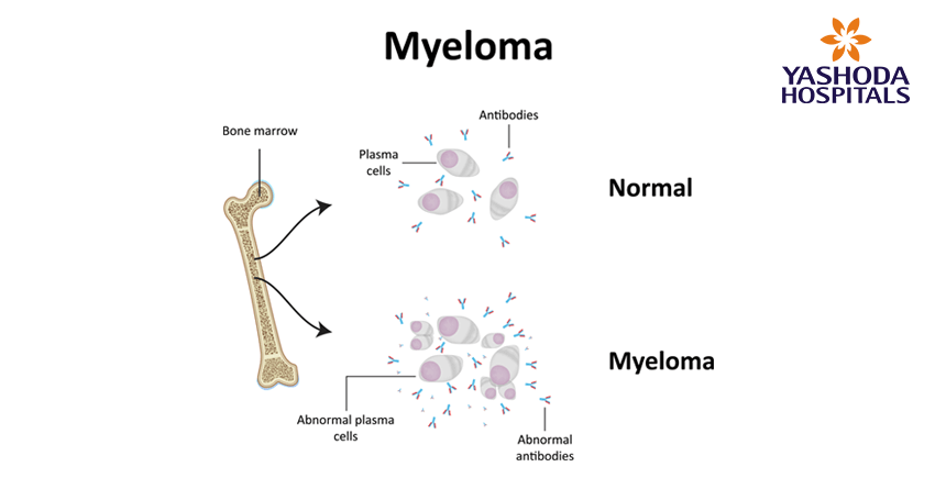 types of blood cancers-myeloma
