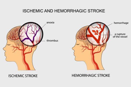 types of brain stroke