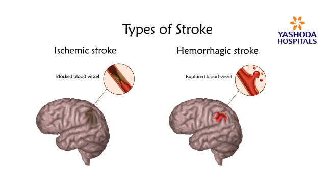 types of strokes