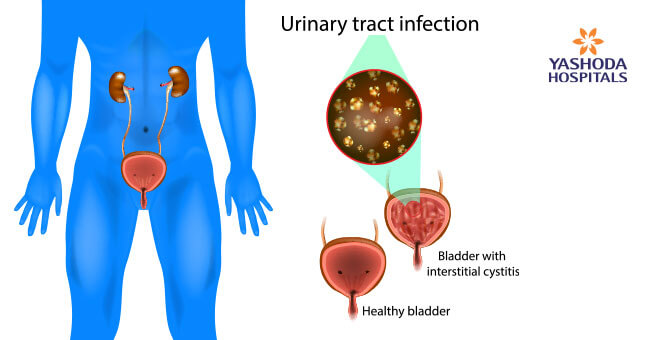 urinary tract infection bladder interstitial cystitis