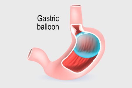 weight loss surgery gastric balloon