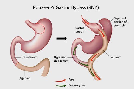 weight loss surgery gastric bypass
