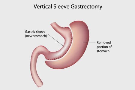 weight loss surgery gastric sleeve