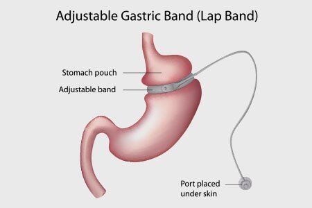 weight loss surgery laparoscopic adjustable gastric banding