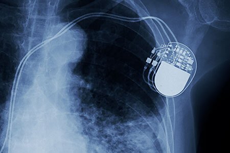 what are implantable heart devices
