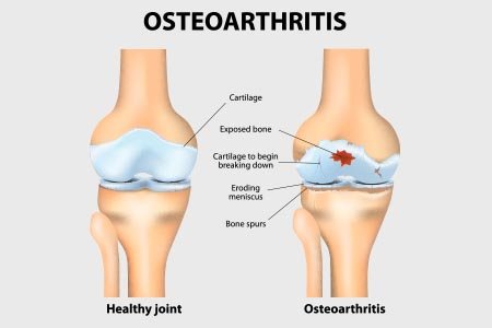 what is osteoarthritis